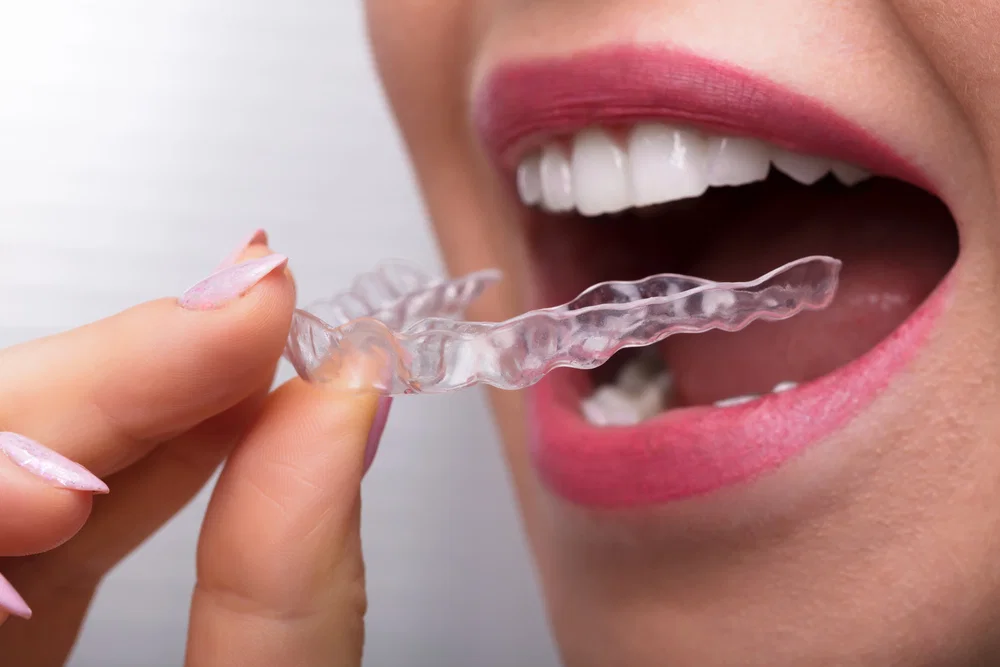 A person holding a clear dental aligner near their open mouth, preparing to insert their invisible orthodontic braces for a perfect smile.