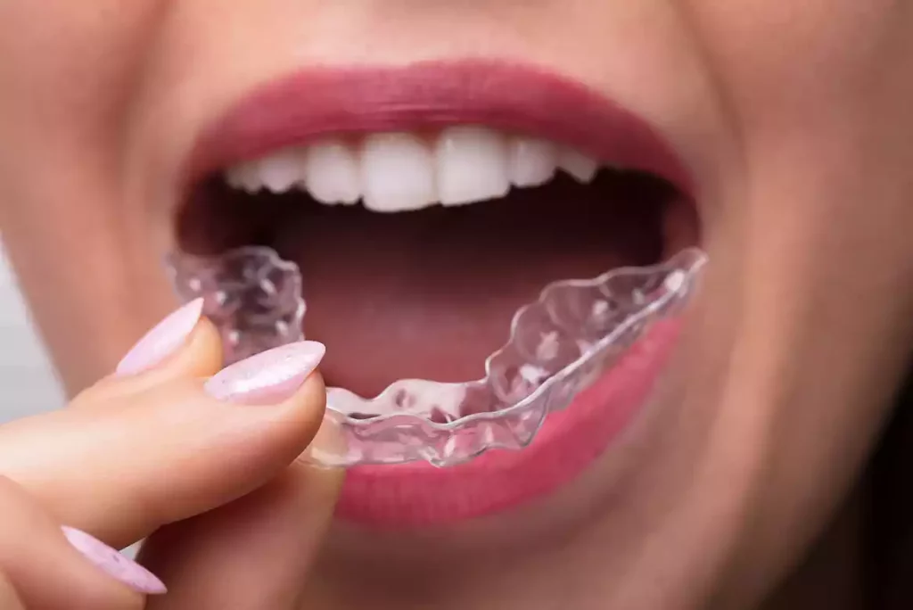 A woman undergoes cosmetic dentistry by wearing a clear aligner in her mouth.