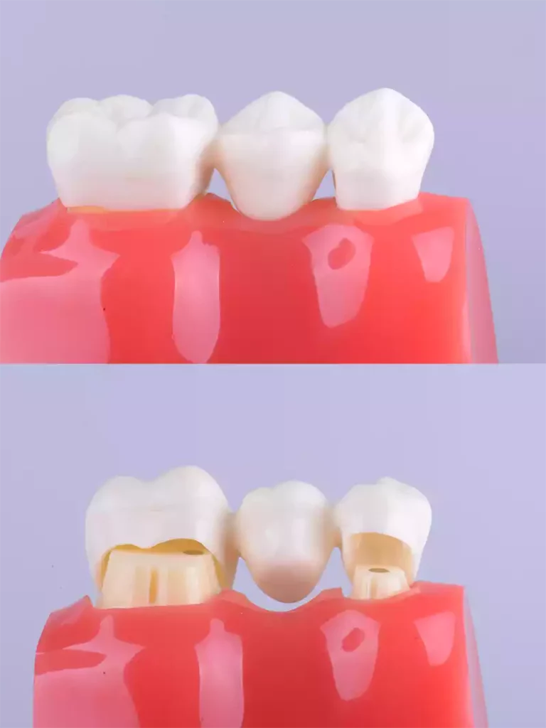 A cosmetic dentistry model showcases a tooth's transformation before and after the placement of a crown.