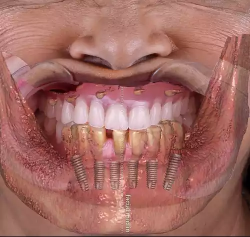 An image showcasing dental implants in a woman's mouth.
