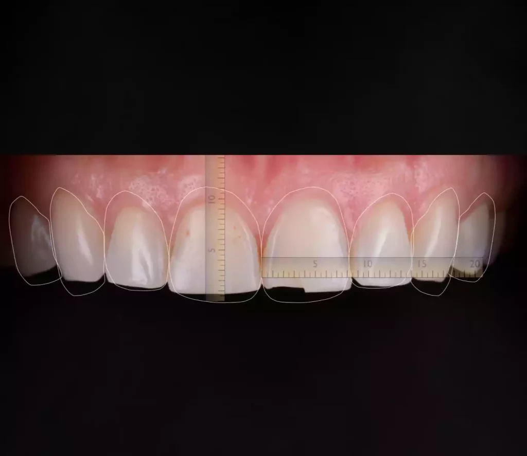 Cosmetic Dentistry: A close up of a patient's teeth for cosmetic evaluation or enhancement purposes.