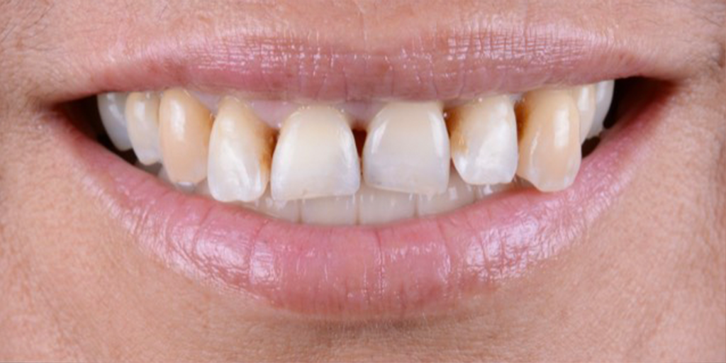 Smile Design: A close up of a woman's teeth showcasing her white smile.