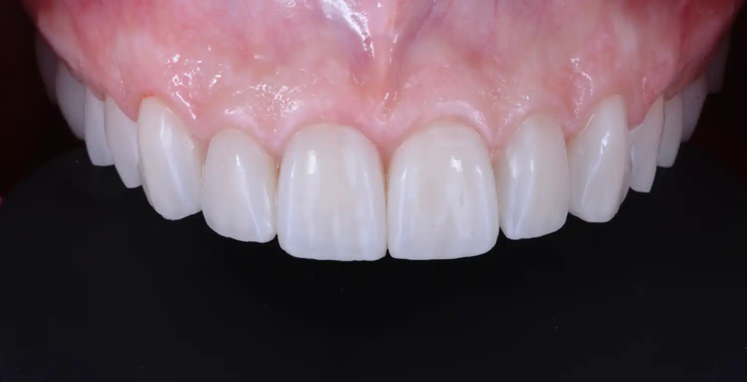 A close up of a patient's teeth in a dental gallery.