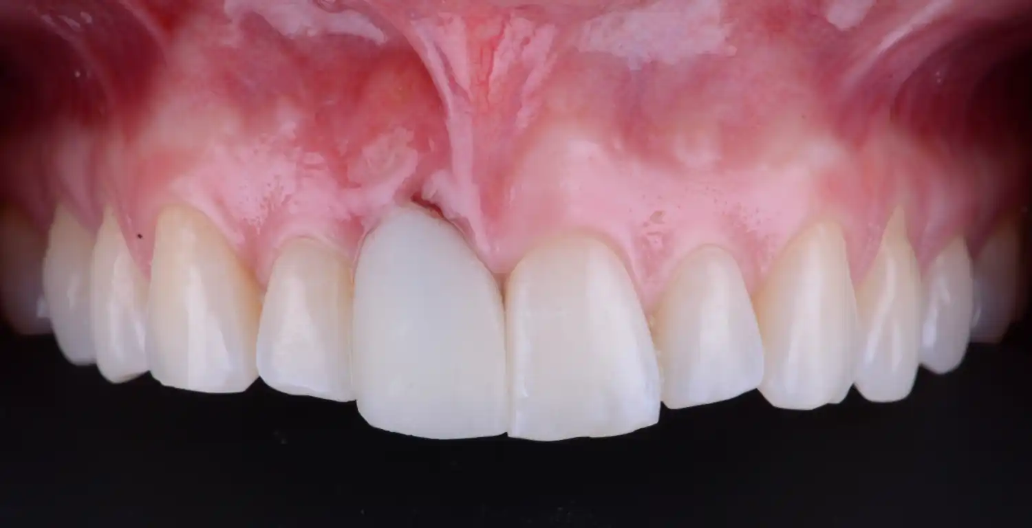 A close up of a patient's teeth featured in a gallery.