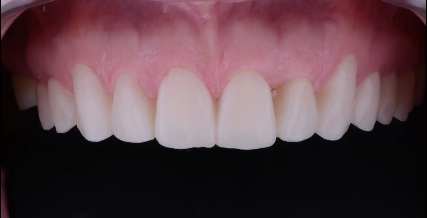 A close up of a patient's teeth in a gallery.