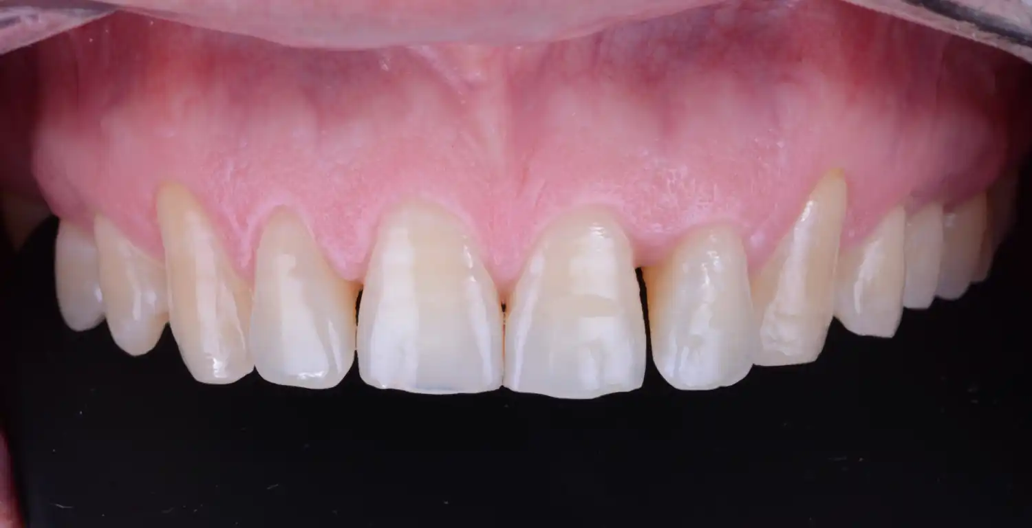 A close-up gallery of a patient's teeth.