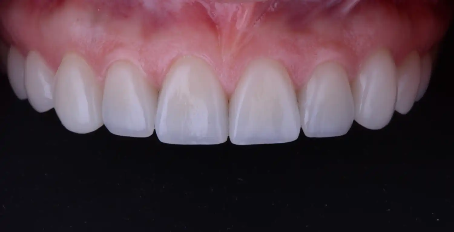 A close up of a patient's teeth in a dental gallery.