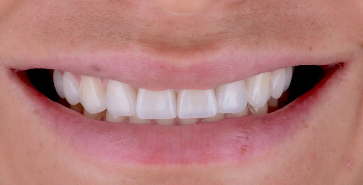 A gallery featuring a woman's close up smile with white teeth.