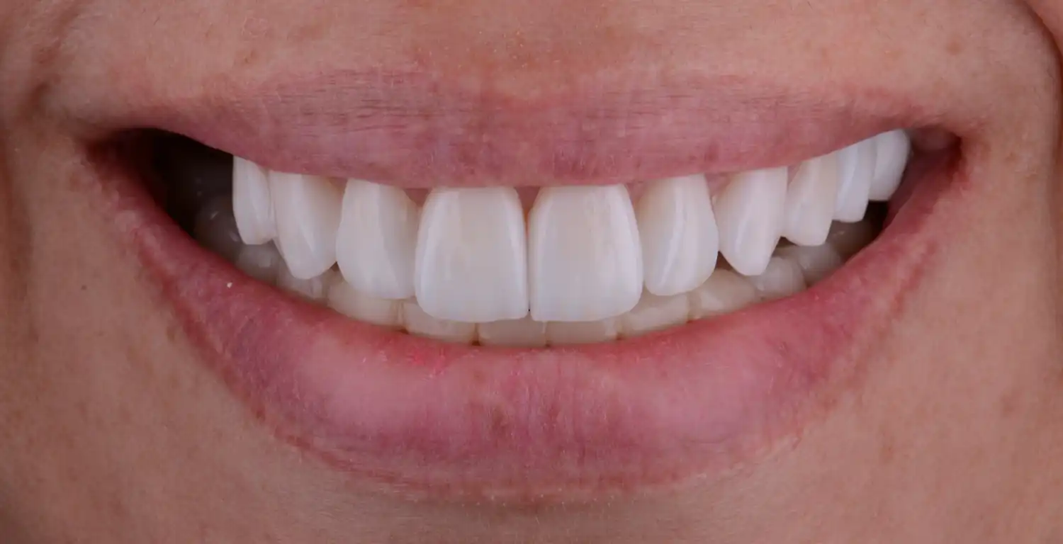 A gallery showcasing a close up of a woman's teeth with white teeth.