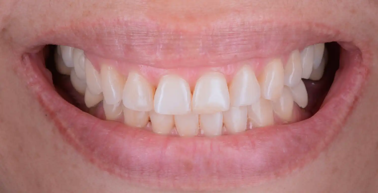 A gallery showcasing a woman's white teeth in close-up.