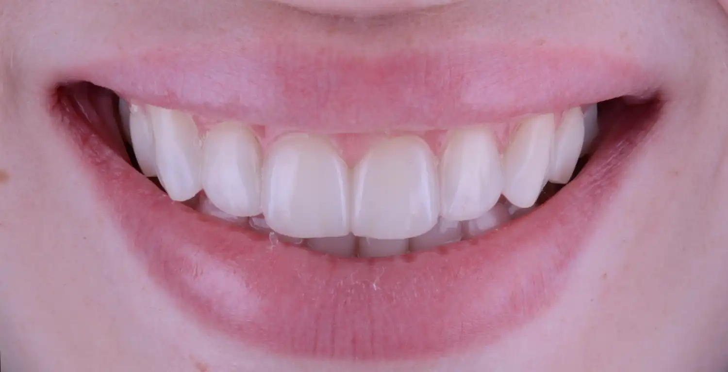 A gallery of close-up shots showcasing women's white teeth.