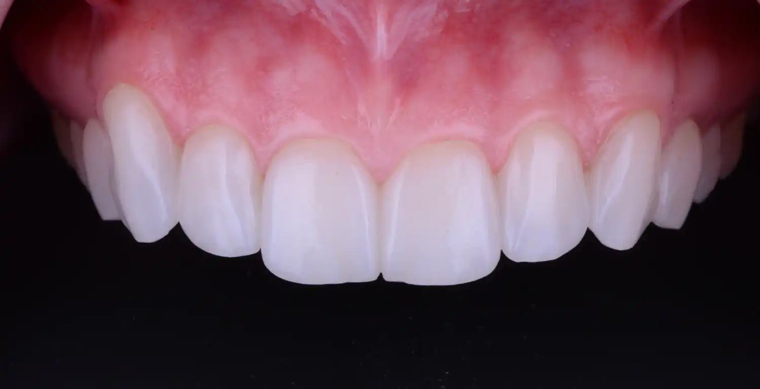 A close-up tooth gallery showcasing white teeth.