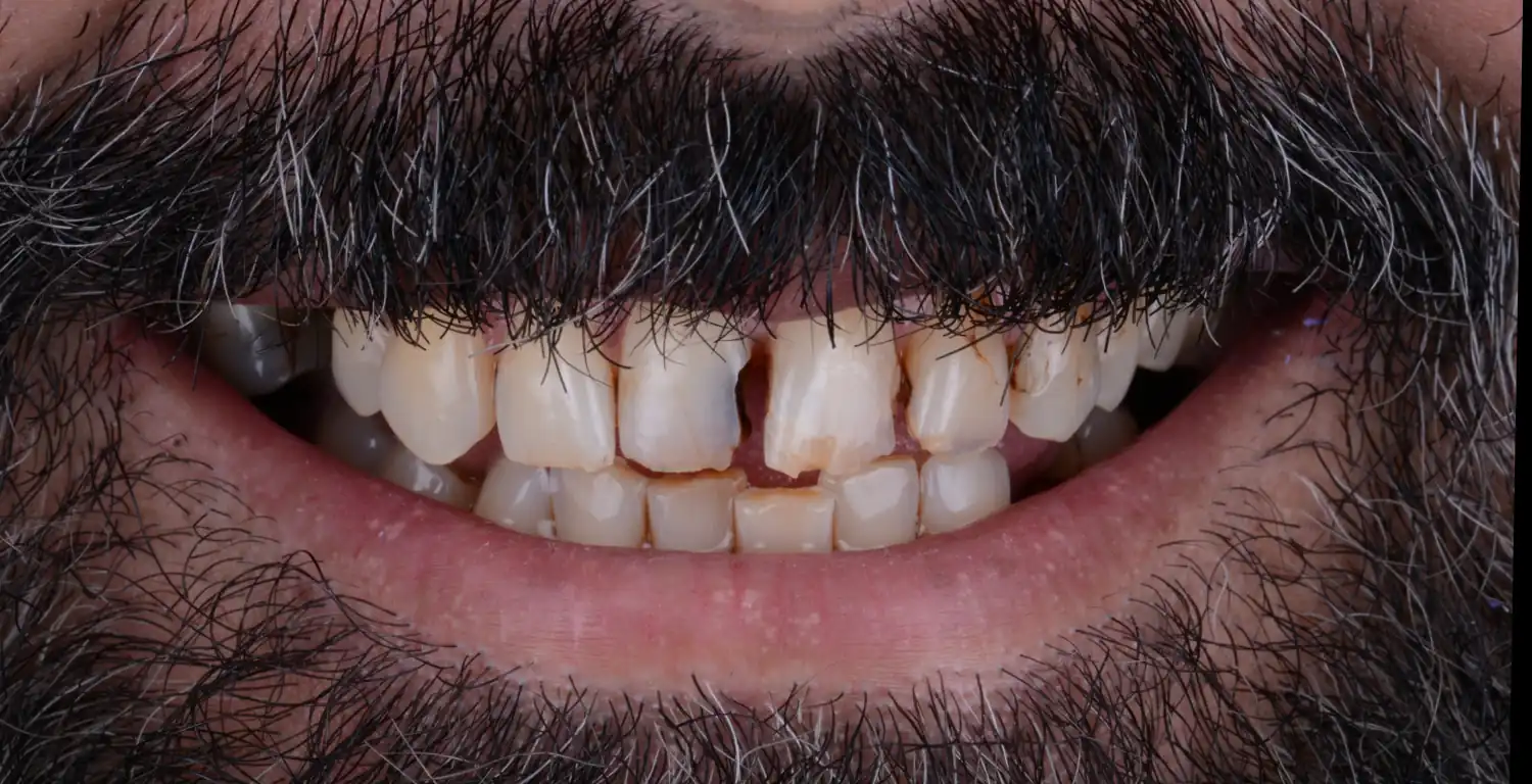 Gallery: Close-up photo of a bearded man's teeth.