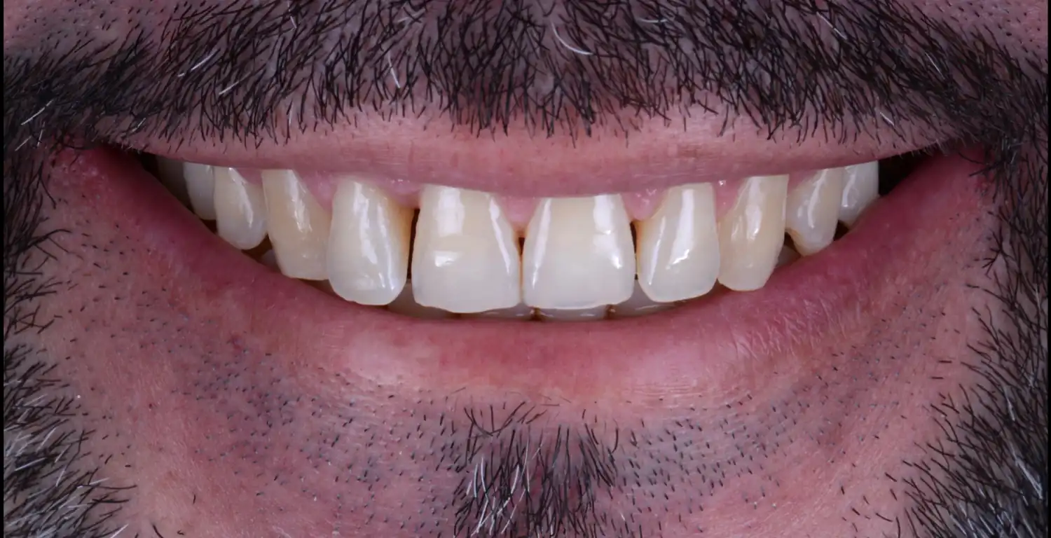 A gallery showcasing a close up of a man's teeth.
