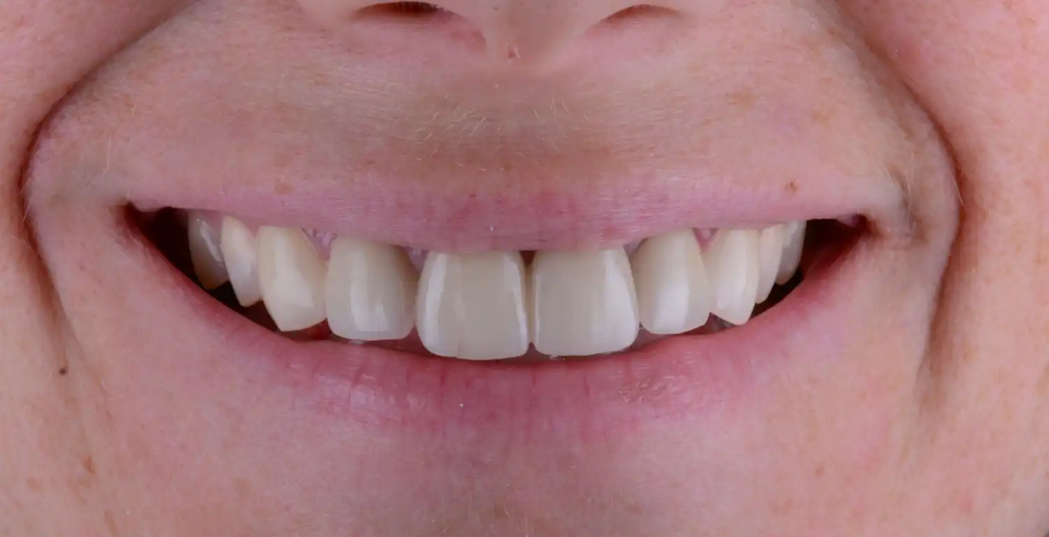 A gallery showcasing close-up smiles with missing teeth.