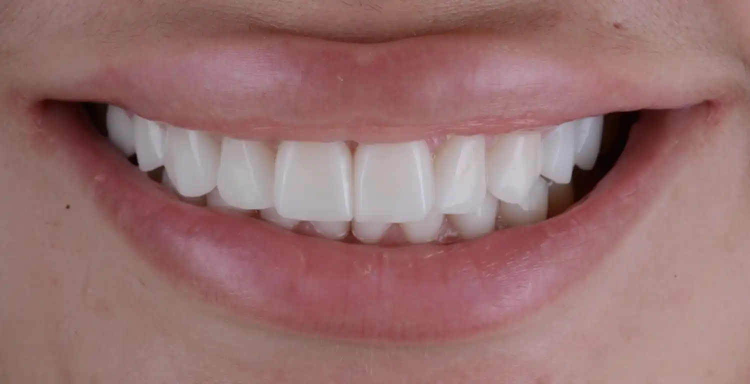 A gallery showcasing close-up shots of women with white teeth.