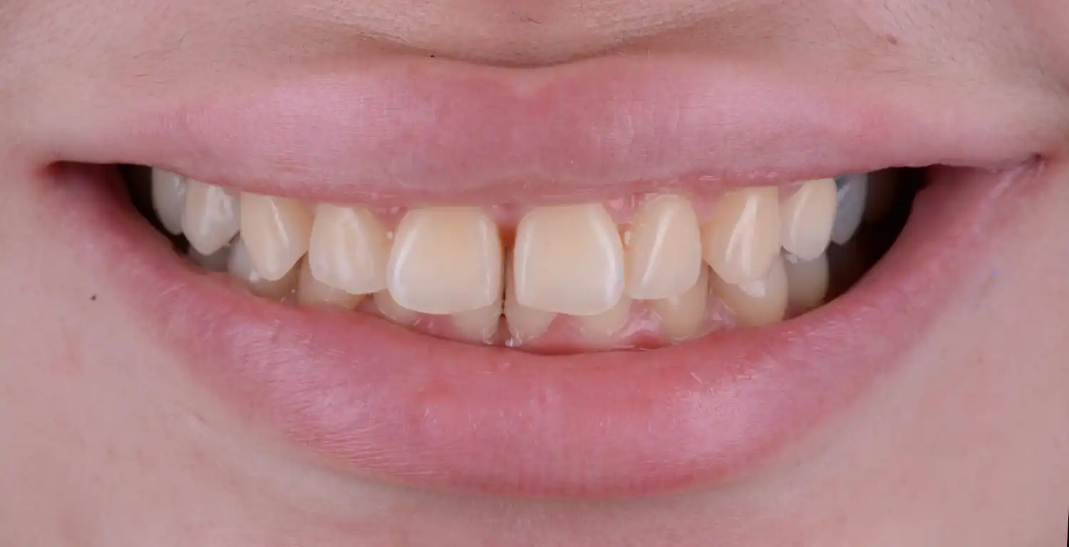 A gallery showcasing the transformation of a woman's teeth before and after a teeth whitening treatment.