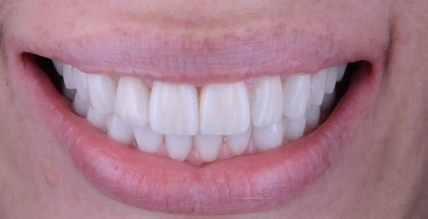 A gallery showcasing a close up of a woman's mouth with white teeth.