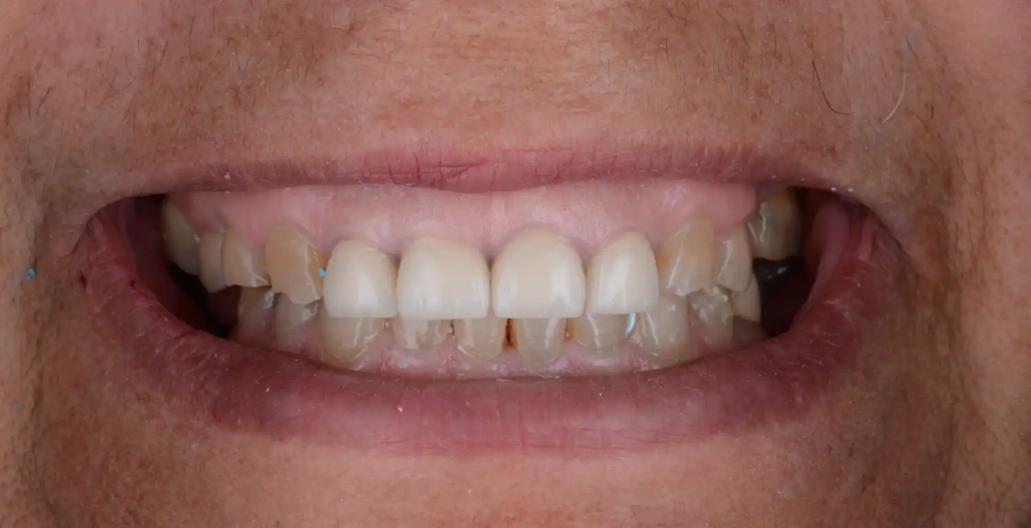 A gallery showcasing a woman's teeth before and after teeth whitening.