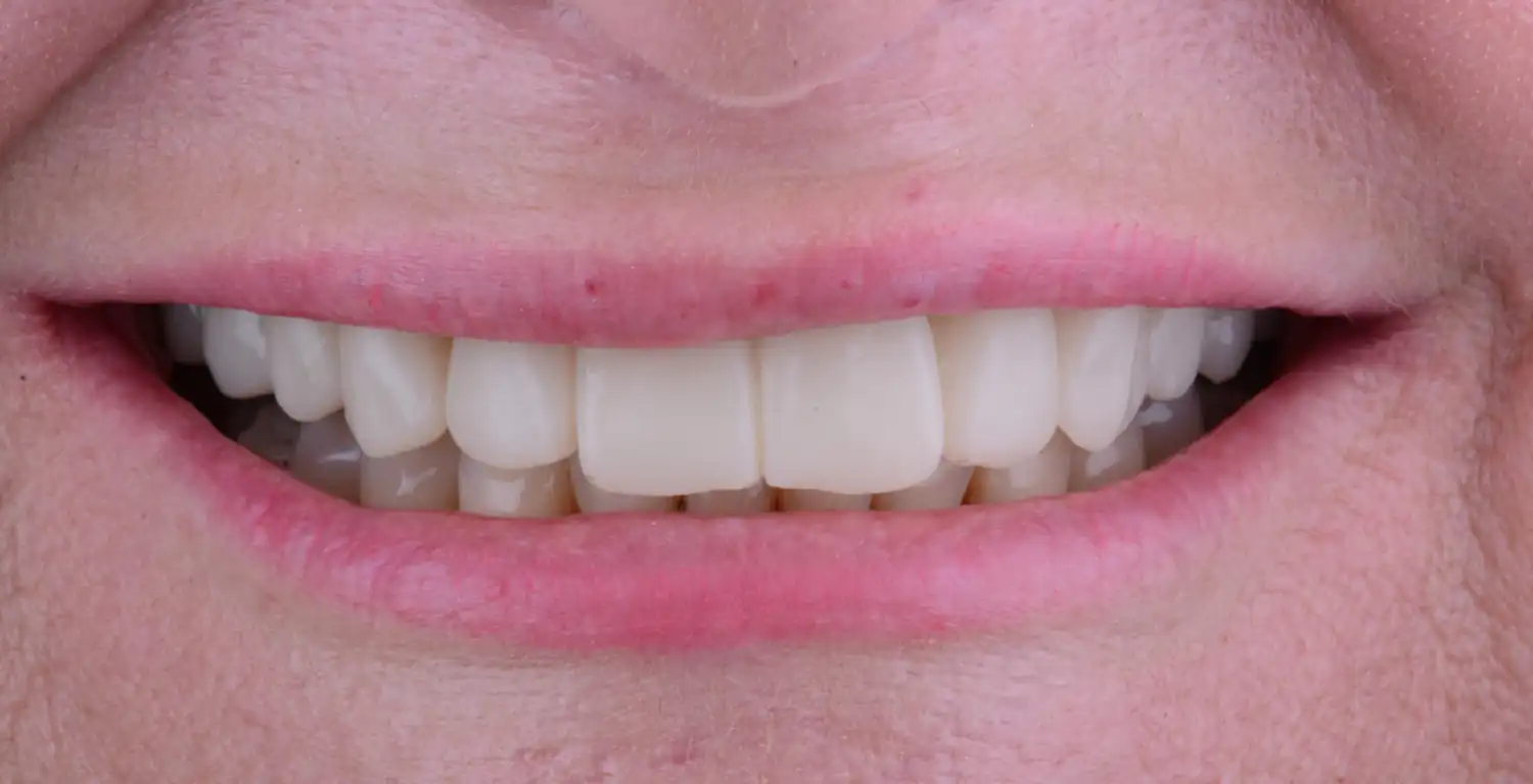 A close up of a woman's smile showcased in a gallery.