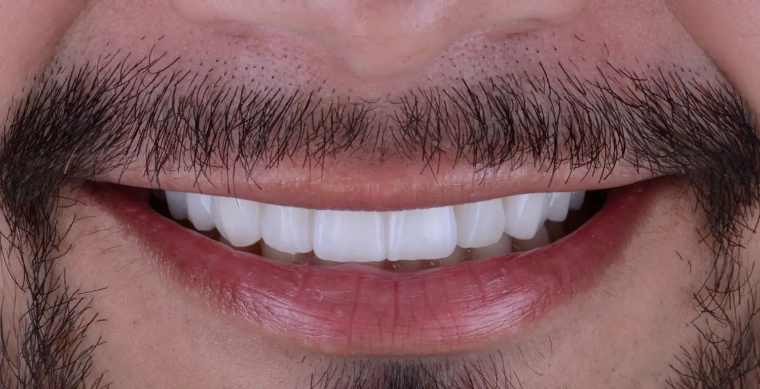 A gallery featuring a close up of a bearded man's teeth.