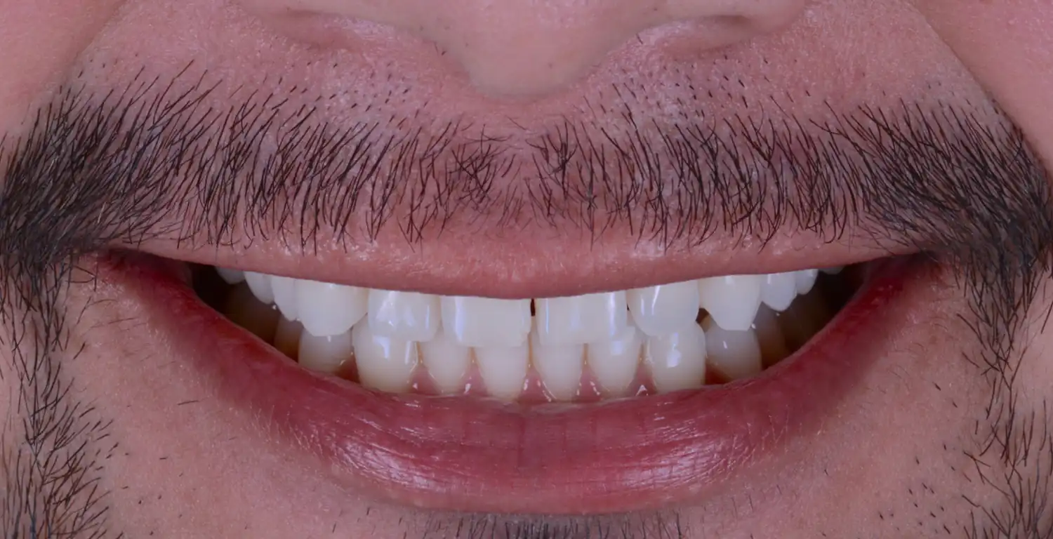 A close up of a man's teeth with a beard featured in a gallery.