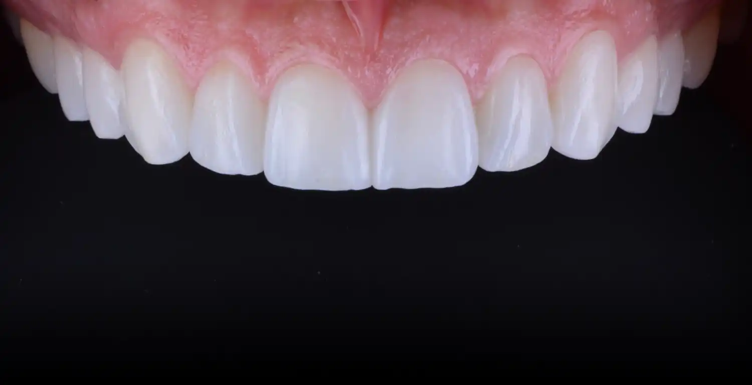 A gallery showcasing a close up of a tooth with white teeth.