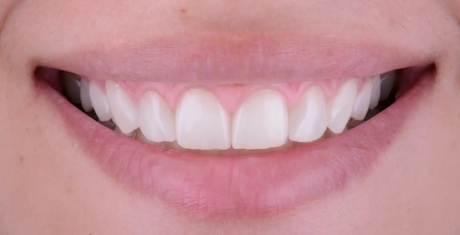 A gallery showcasing a close up of a woman's teeth.
