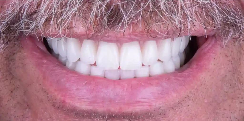 A close up of a man's teeth with a mustache showcasing an All On Six implant restoration.