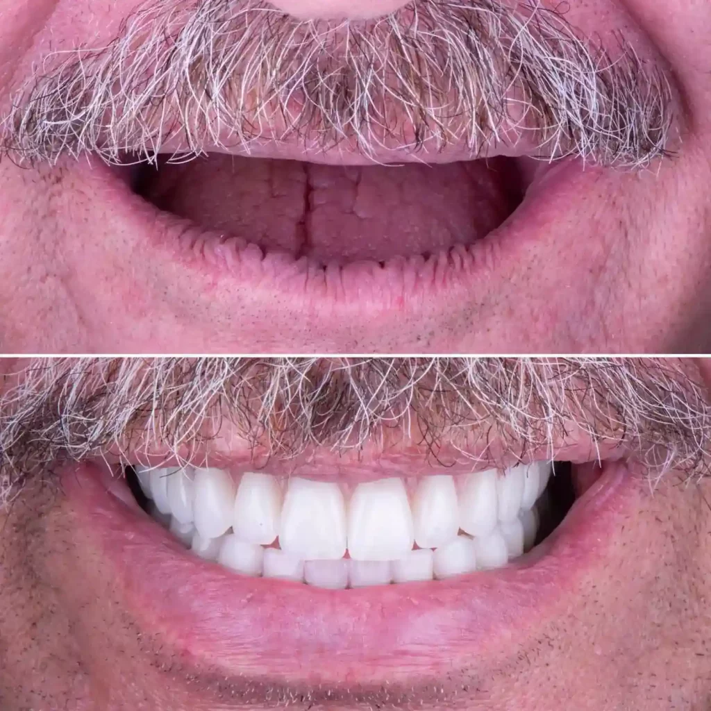 A man's smile transformation with dental veneers featuring All On Six.