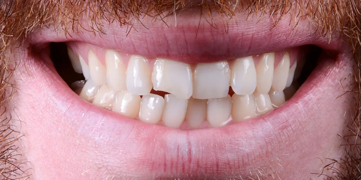 A close up of a man's mouth undergoing cosmetic dentistry with missing teeth.
