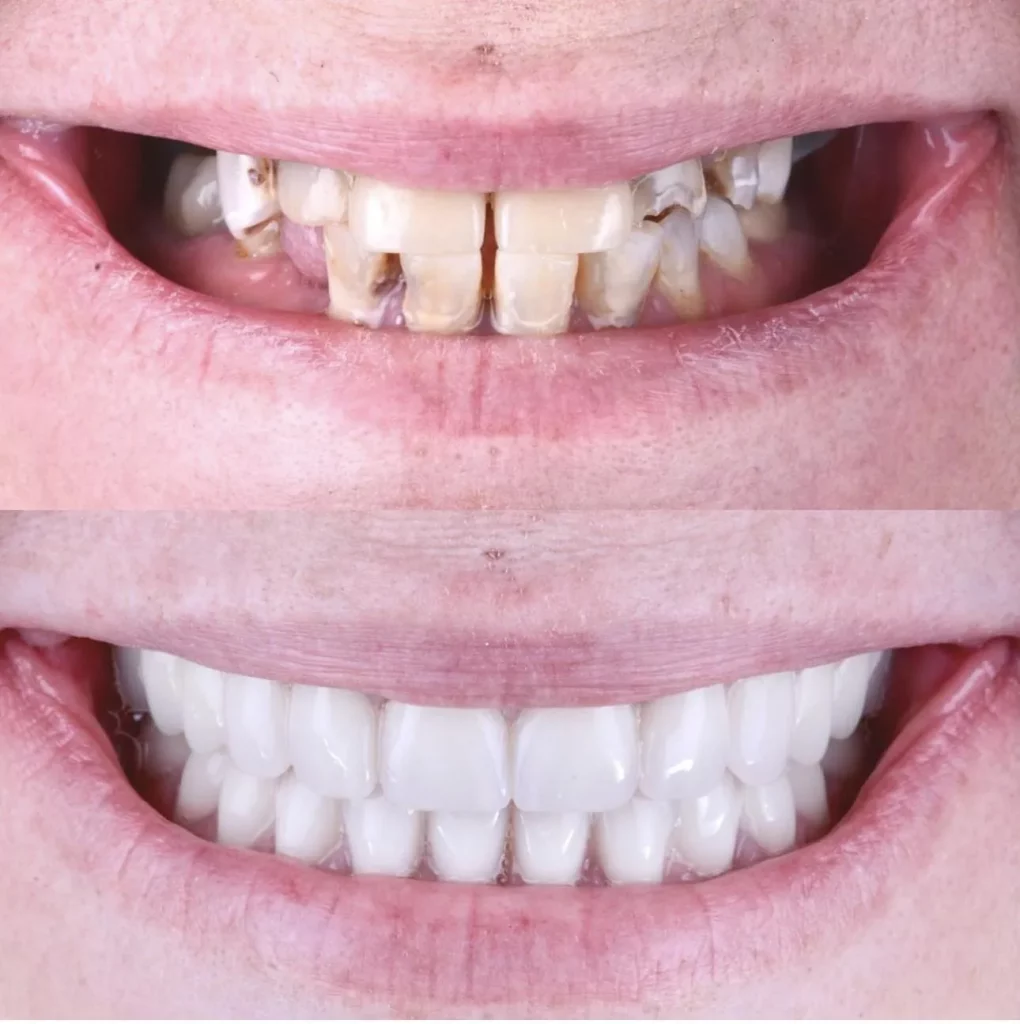 A patient's teeth before and after dental veneers with dental implants.