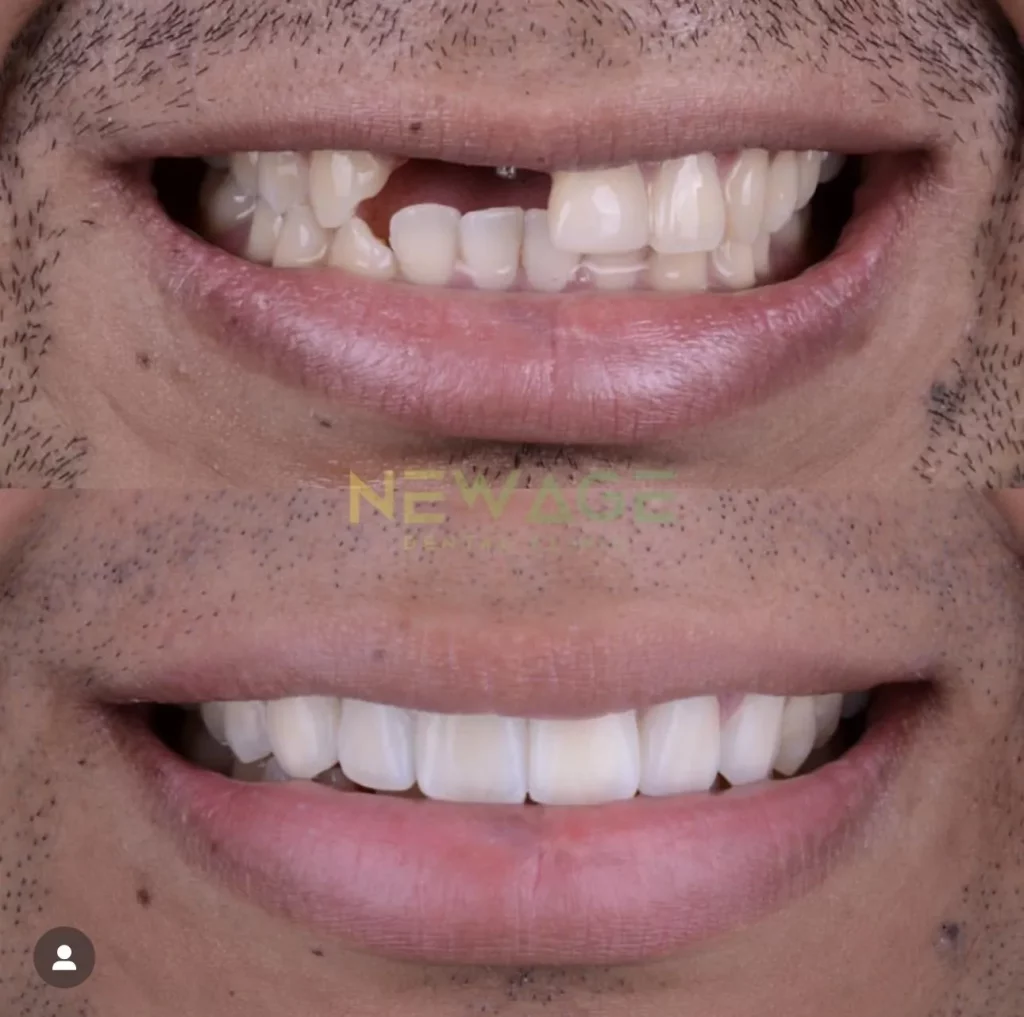 Before and after dental implants for a man's teeth transformation.