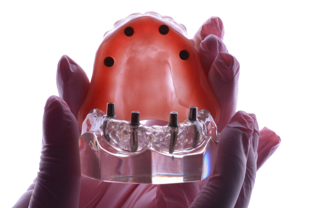 A model of a dental implant held by a hand, addressing questions about dental implants in Tijuana.