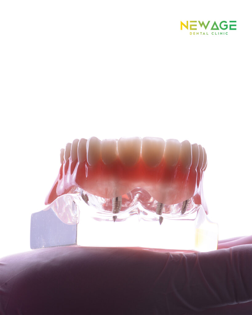 A person is holding a dental model to demonstrate the cost-saving benefits of dental implants in Tijuana, Mexico.