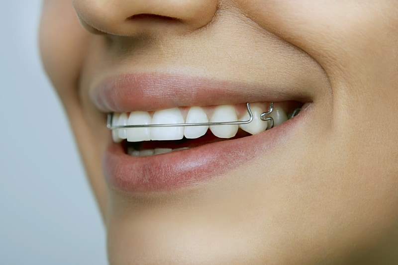 A woman smiles with braces on her teeth in Tijuana.