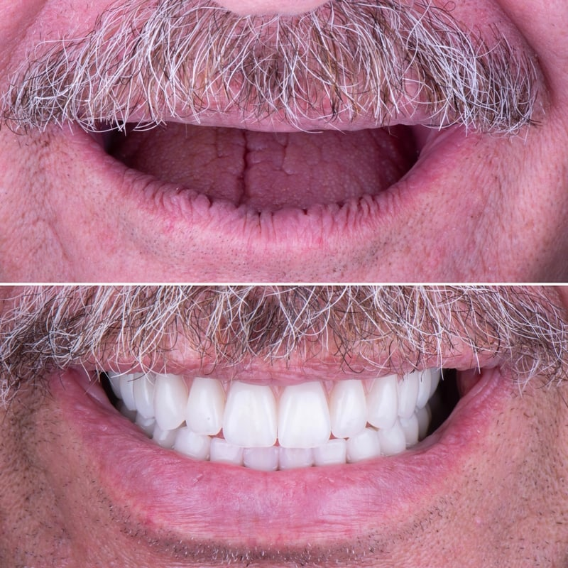 Cost & Benefits: Dental Implants in Mexico 1 image 62