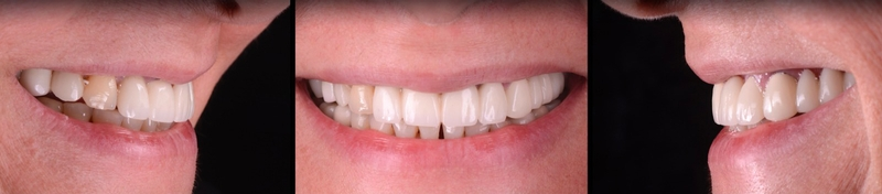 Cost & Benefits: Dental Implants in Mexico 3 image 63