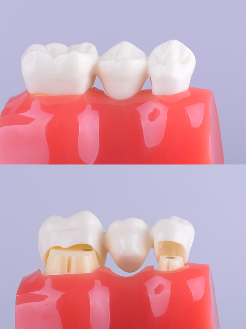 Cost & Benefits: Dental Implants in Mexico 4 image 64