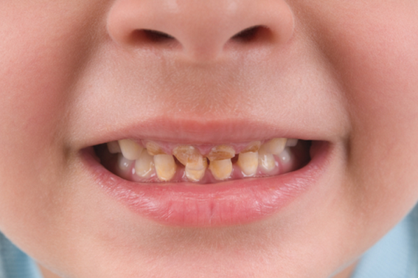A child's teeth are showing signs of decay and pediatric dentistry.