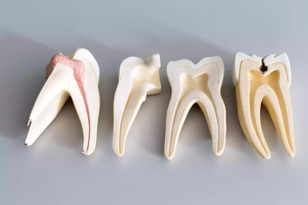 A model of a tooth is shown on a grey background, debunking 5 myths about Root Canals in Tijuana.