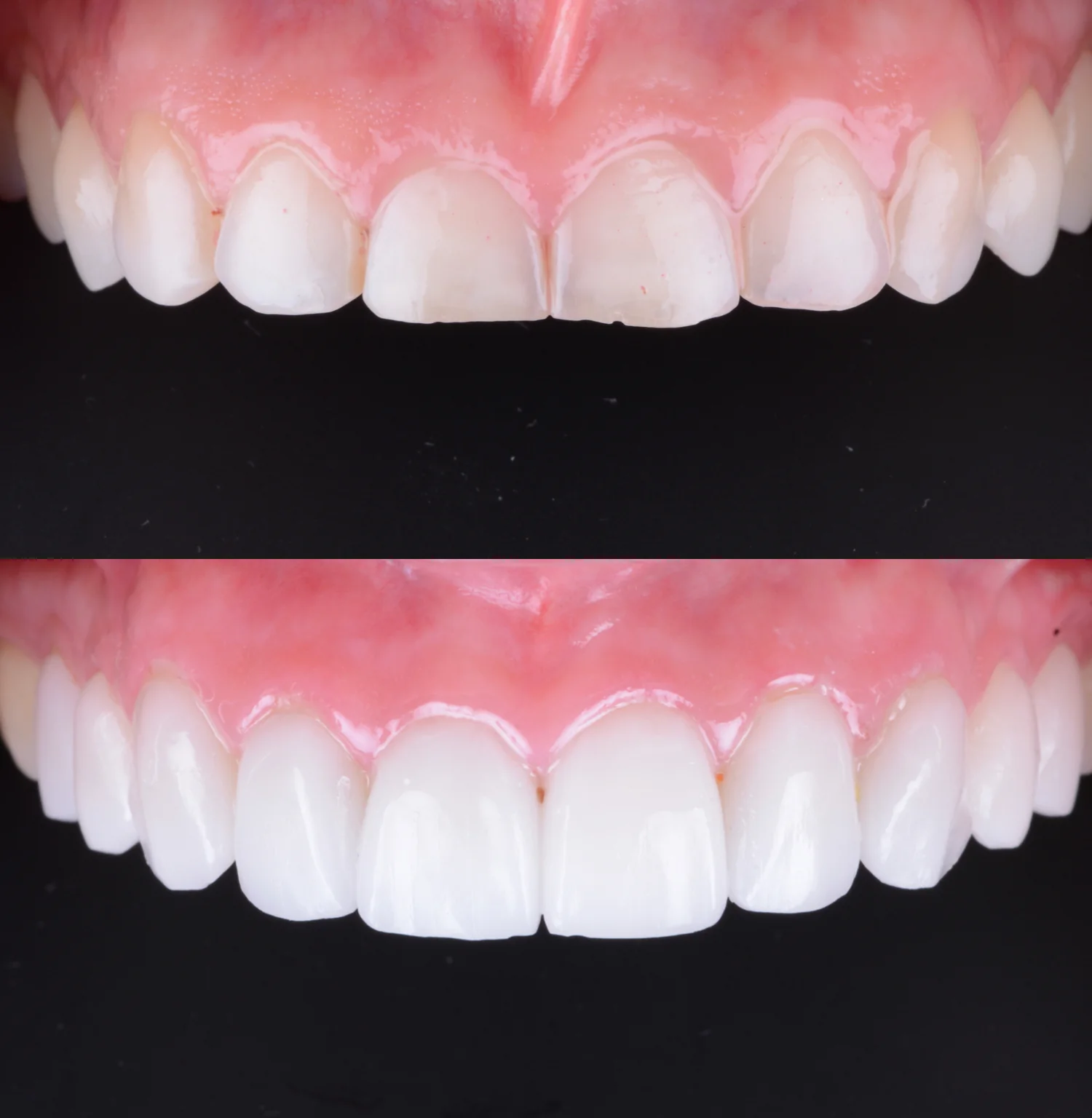Before and after teeth whitening and veneers.