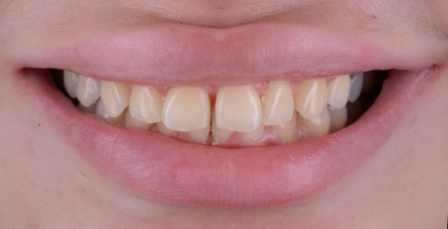 A close up of a woman's teeth before and after teeth whitening using a KR whitening kit.