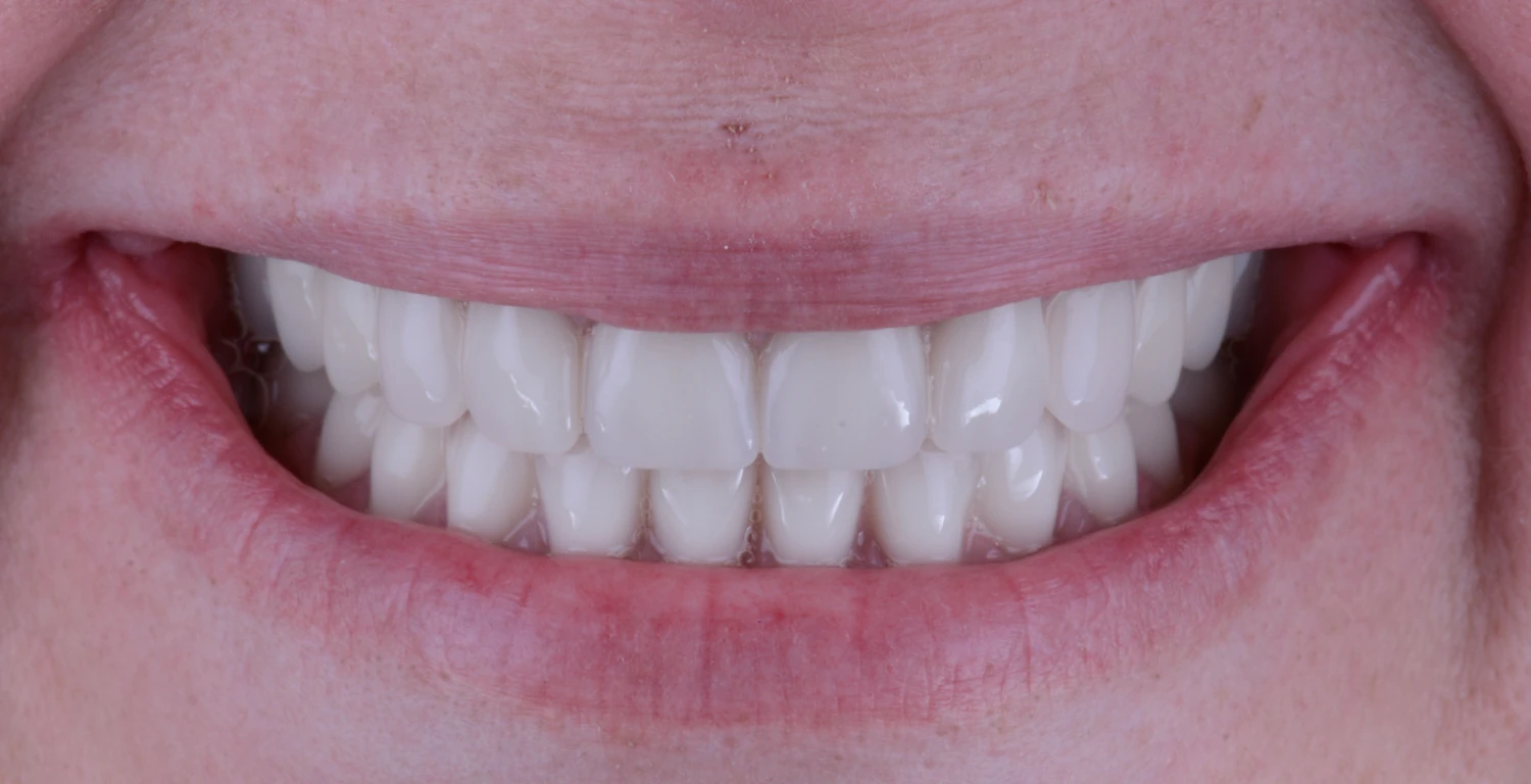 A close up of a woman's bright smile with white teeth achieved through All-on-Six dental treatment.