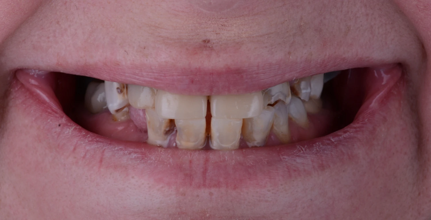 A close up of a woman's missing teeth.