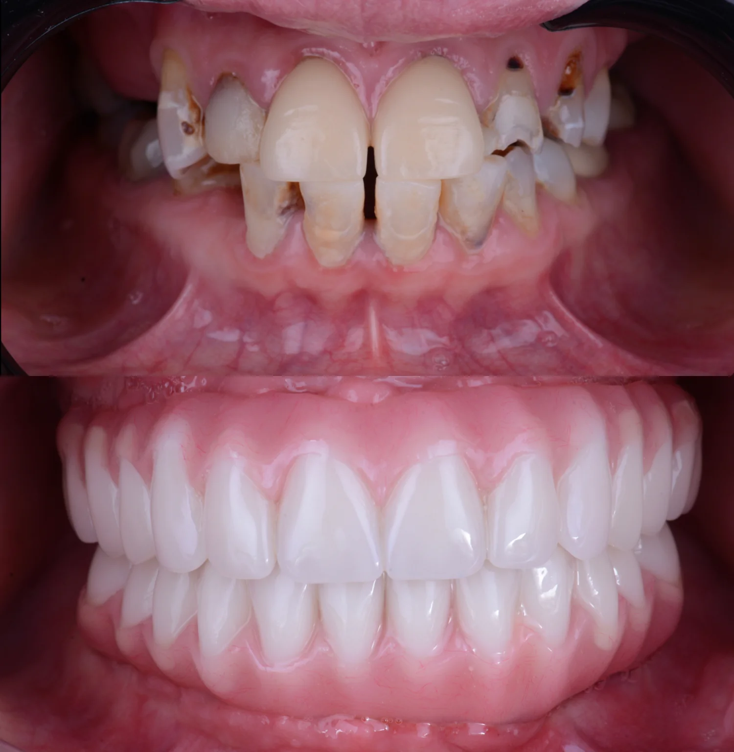 KR LP All-on-Six 4 all on 6 37 before-after