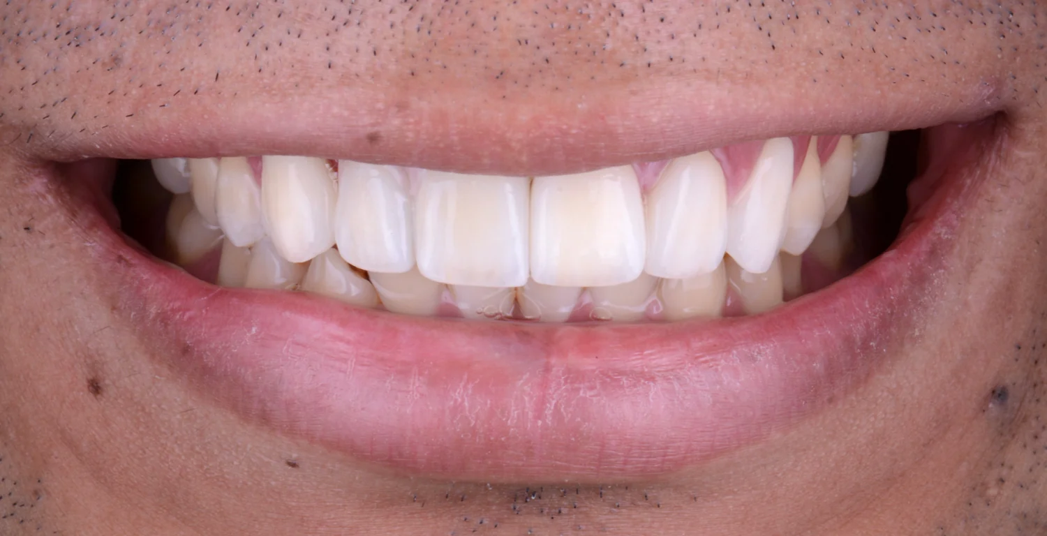 A close up of a man's mouth with gleaming white teeth after receiving KR dental implants.