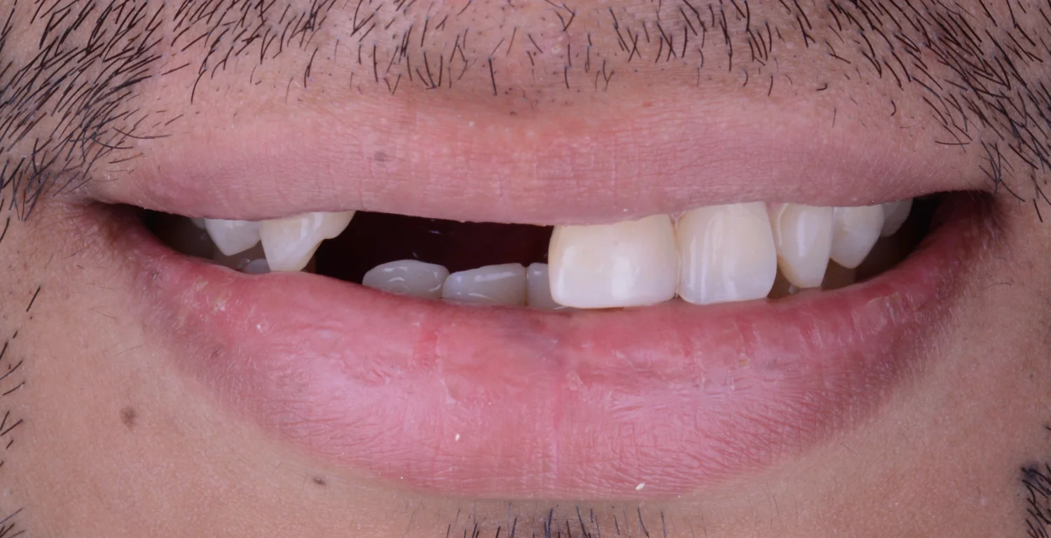 A close up of a man's mouth with missing teeth being replaced by dental implants.