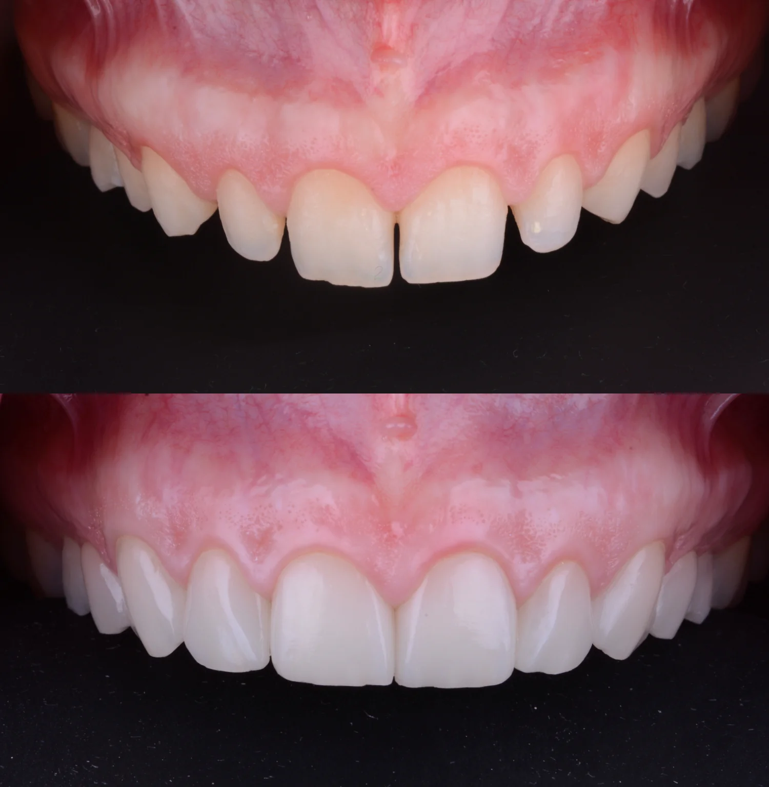 A patient's teeth transform after receiving KR Veneers.
