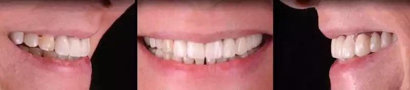 Perfecting Your Smile: The Art of Dental Contouring 6 A person's teeth undergo dental contouring, reflecting changes before and after the procedure.